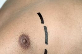 Who Are the Best Candidates for Gynecomastia Surgery?